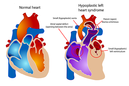 diagram of hearts